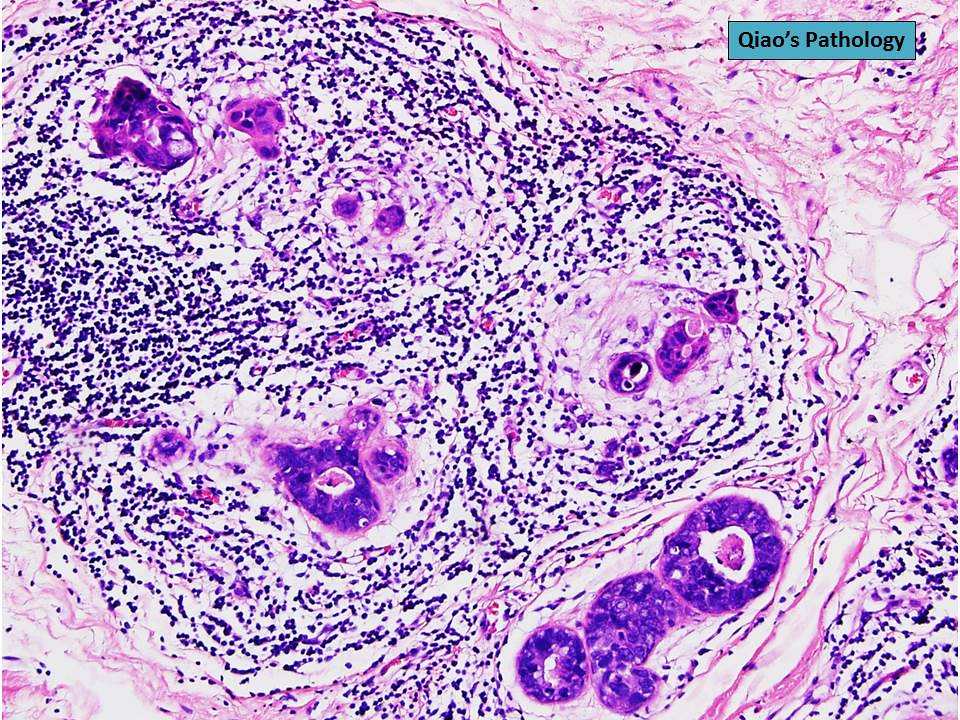 Qiao's Pathology Cancerization of Lobules Microscopic pho… Flickr