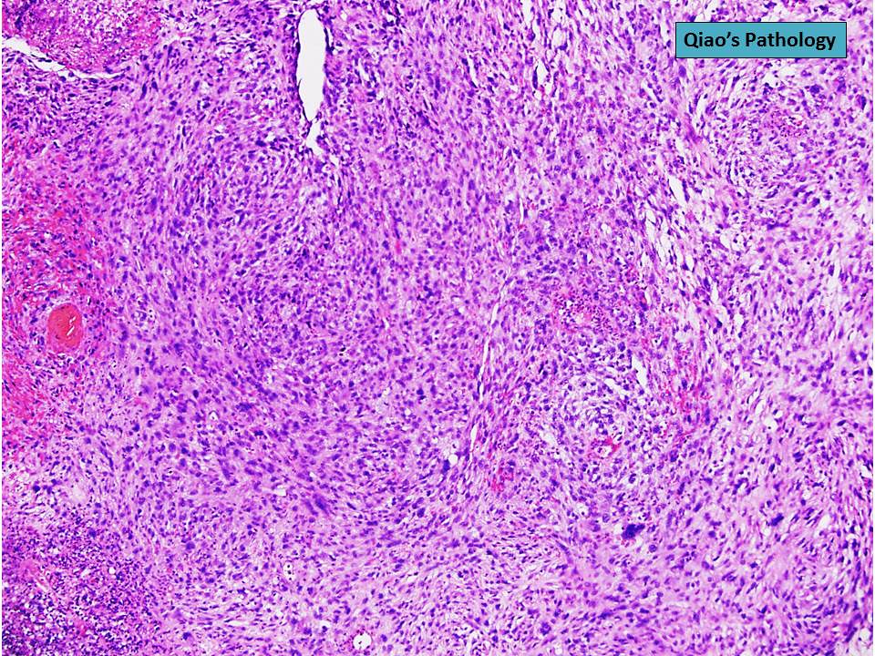 Qiao's Pathology (Spindle Cell) Carcinoma of … Flickr