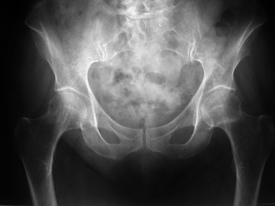 Impacted, undisplaced left femoral neck fracture, pelvis