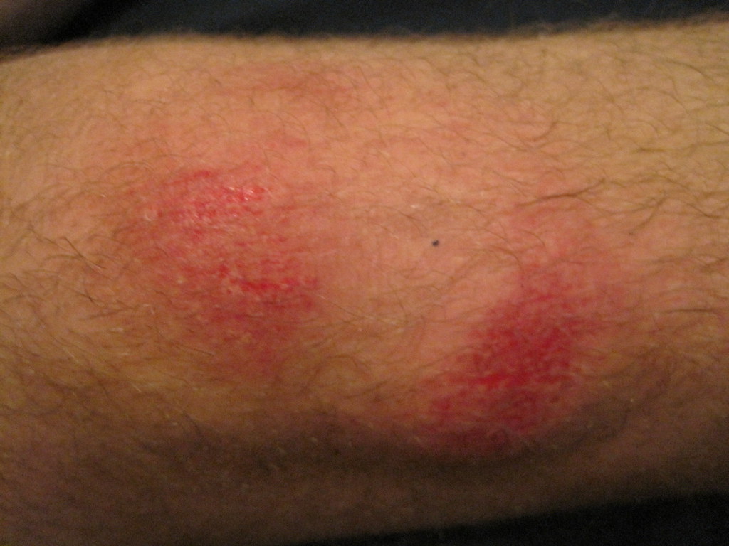 All sizes Ryan's nasty AstroTurf scrape/burn. Ouch! Flickr Photo