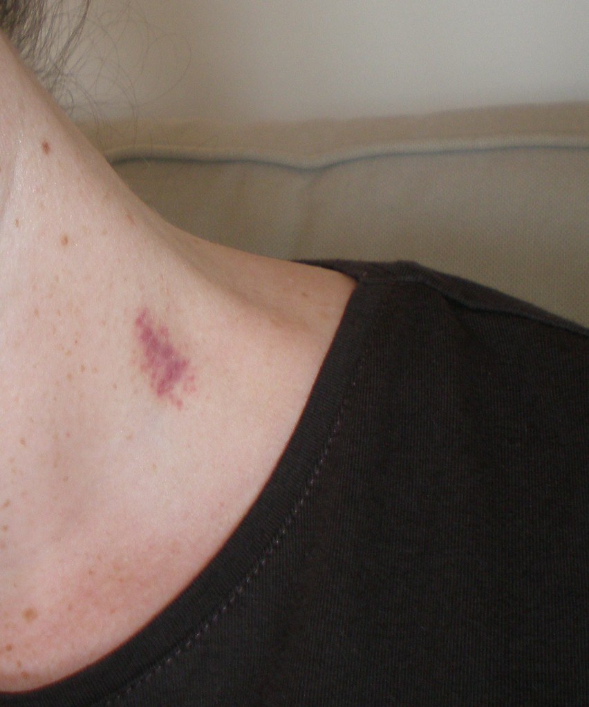 love bite hickey Littlelixie Flickr