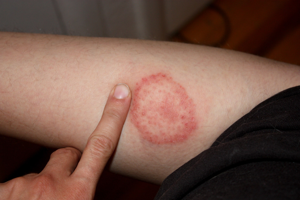 so, I have lyme disease After three weeks of trying to