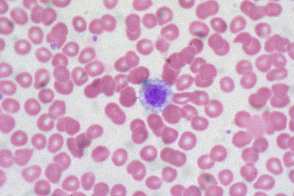 Giant Platelet, Peripheral Blood Smear Ed Uthman Flickr