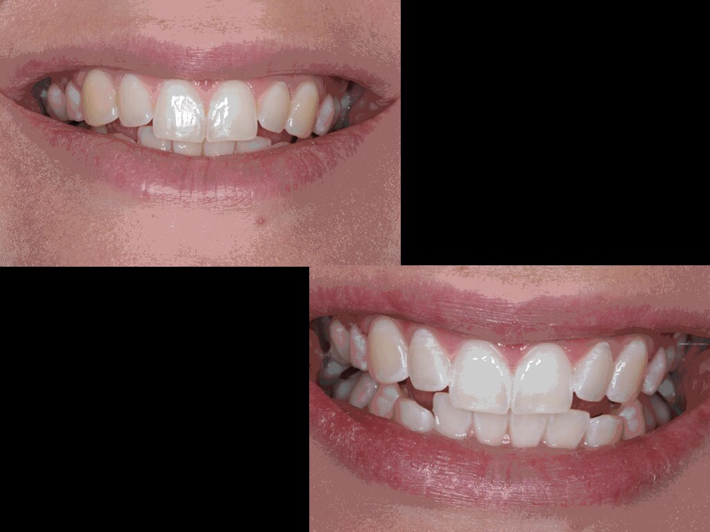 whitening_imge3 Teeth whitening example, an amazing