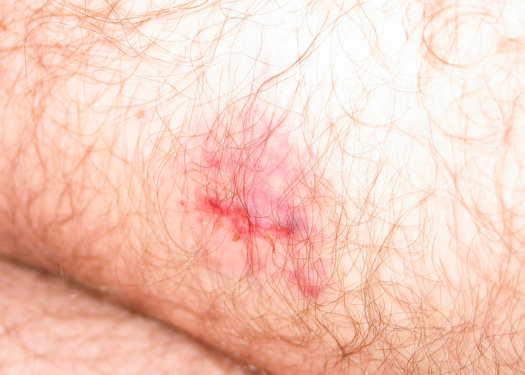 Dog Bite Closeup (IMG_3589) I was bitten on the back of my… Flickr