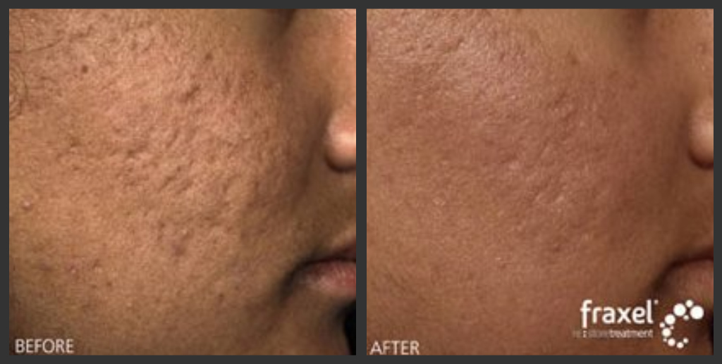 Fraxel Before & After Acne Scar Laser Removal www.AboutFa… Flickr