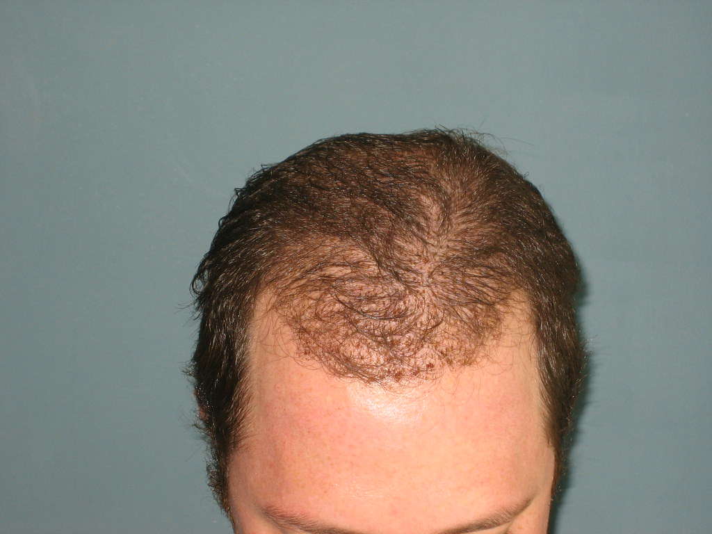 8 Days After Bosley Hair Restoration Procedure Follow my B… Flickr