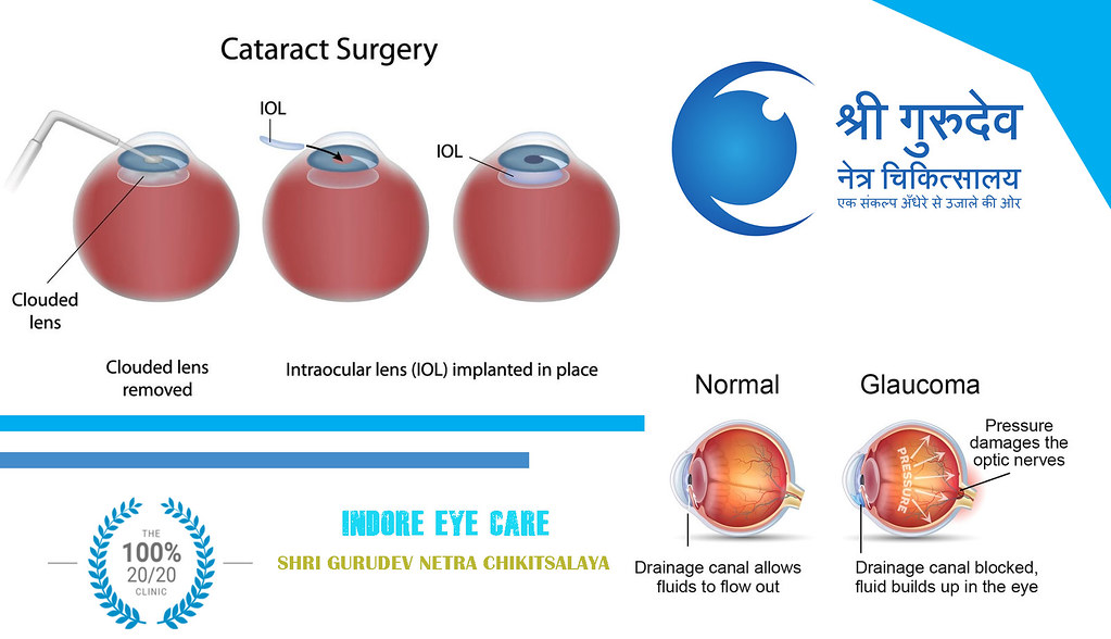 Best Eye Care Hospital Near you in Indore We are providing… Flickr