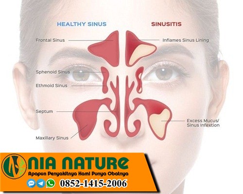 Pilek Menahun Yang Sudah Bertahun Tahun SEMBUH SEKETIKA
