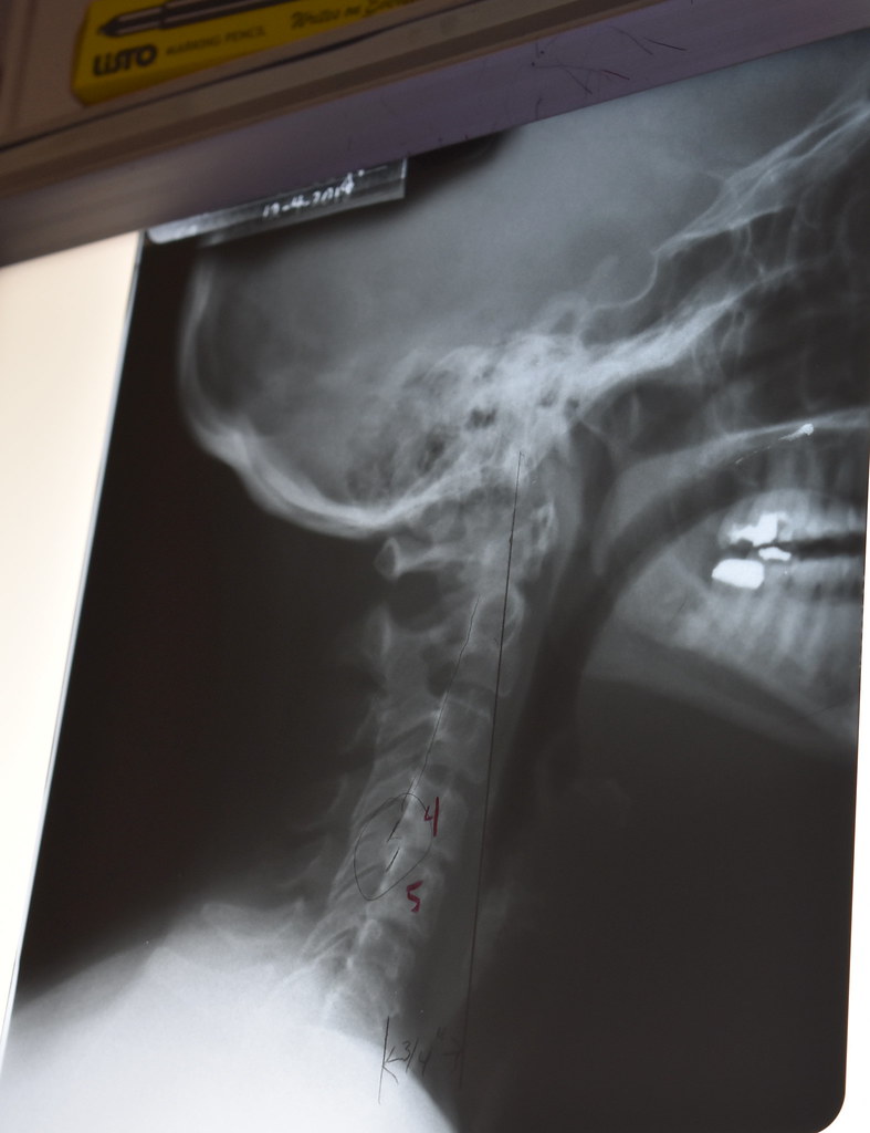 Neck XRay Car Accident a photo on Flickriver