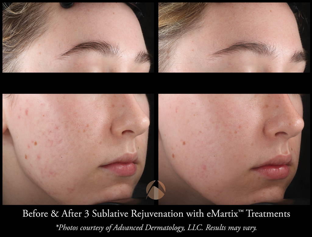 Sublative Rejuvenation with eMatrix Treatment Chicago, IL Advanced