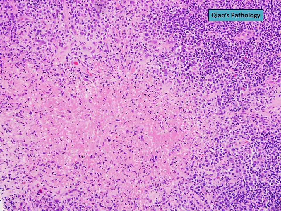 Qiao's Pathology Cat Scratch Disease a photo on Flickriver