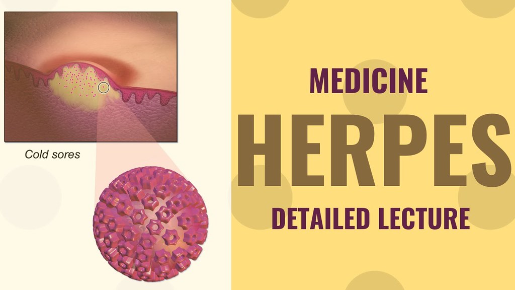 What is Herpes Virus infection and how to treat it ? Detai… Flickr