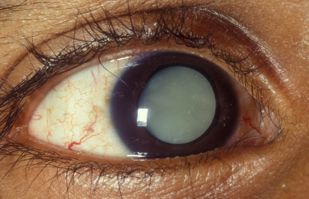 Age related cataract A case of agerelated cataract (histo… Flickr