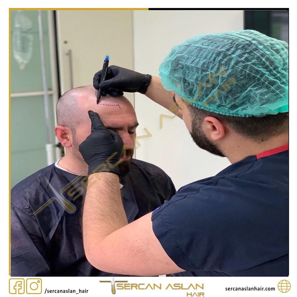 Hair Transplant in Istanbul Turkey Hair Transplant in Ista… Flickr