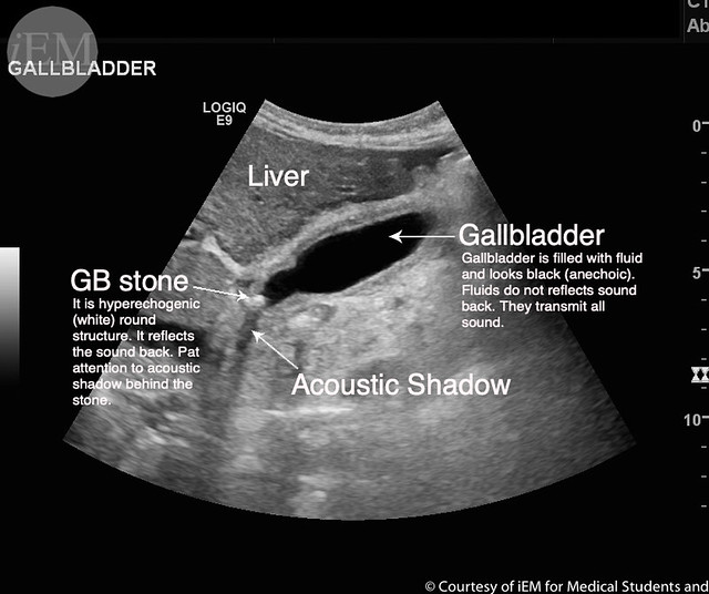 251 Gallbladder stone with thickened wall Gall bladder i… Flickr
