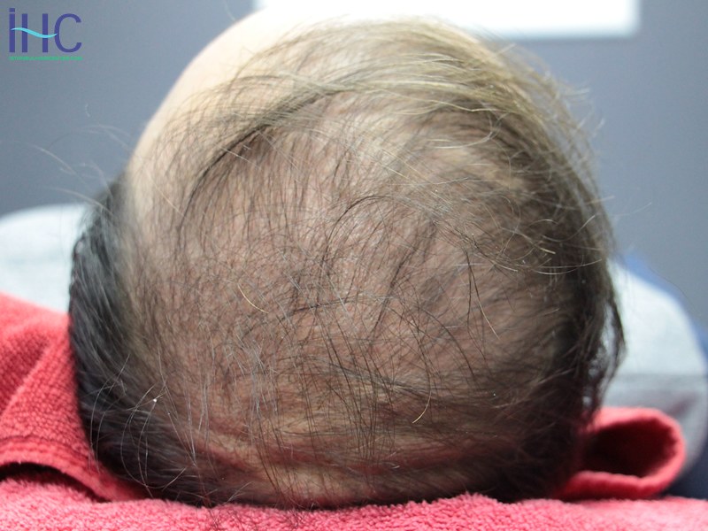 Insomnia and Hair Loss Disorders Hair loss problems due to insomnia