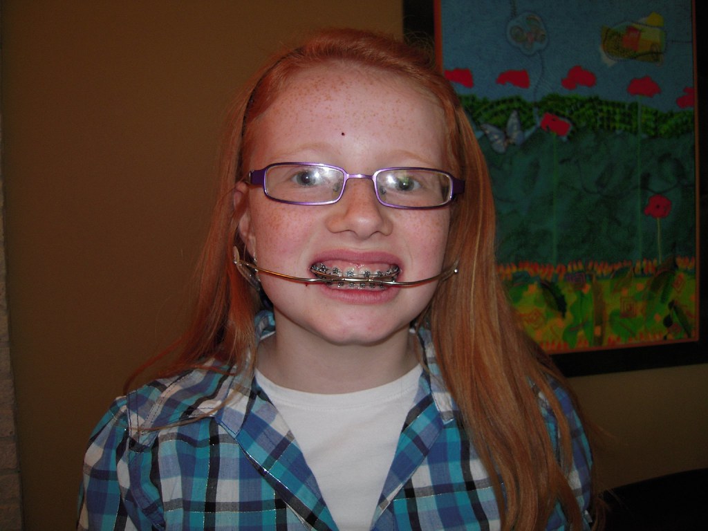 Untitled braces headgear Flickr