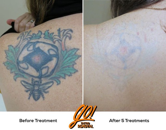 Laser Tattoo Removal Absolutely amazing results after 5