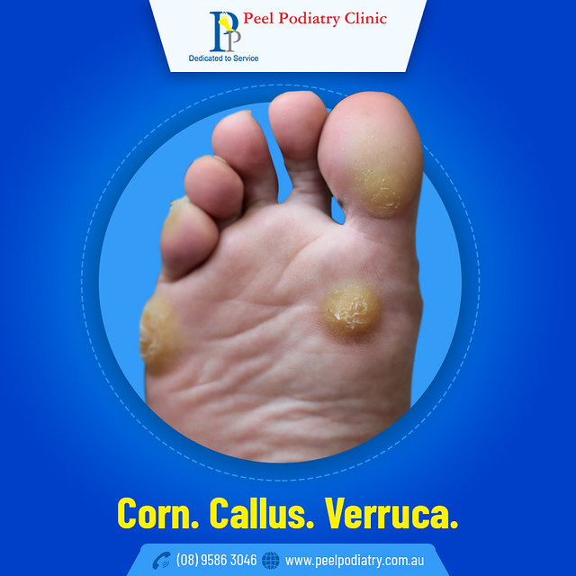 Corn, Callus or Verruca Which One is Causing Pain on my F… Flickr