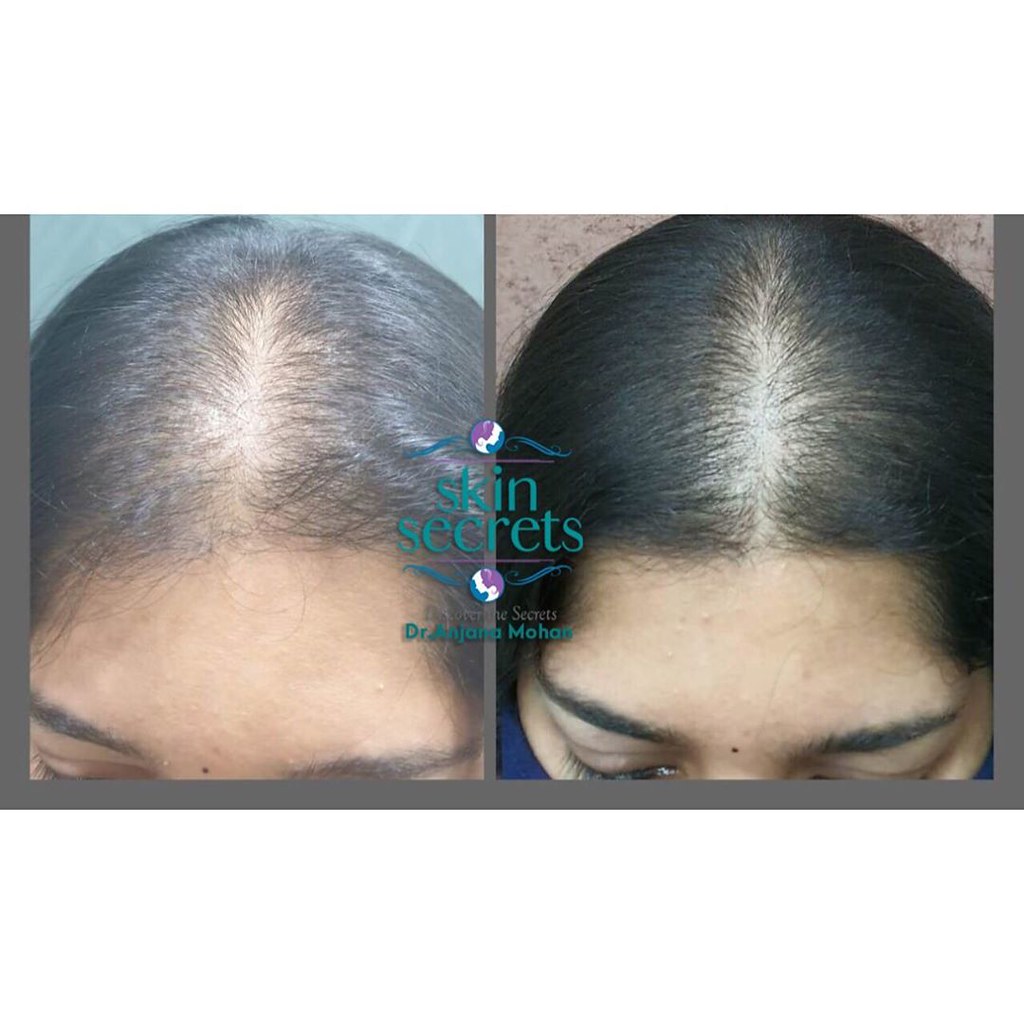 Hair Care Treatments Kochi Skinsecrets signature Hair Loss… Flickr