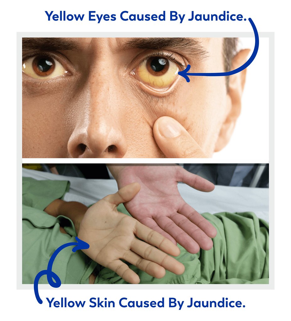 Jaundice photos of yellow eyes and skin caused by jaundice… Flickr