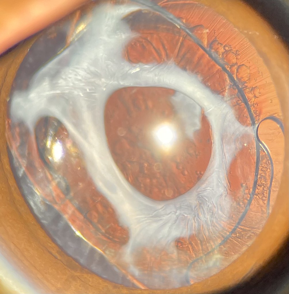 Capsular phimosis Amit Mishra Flickr