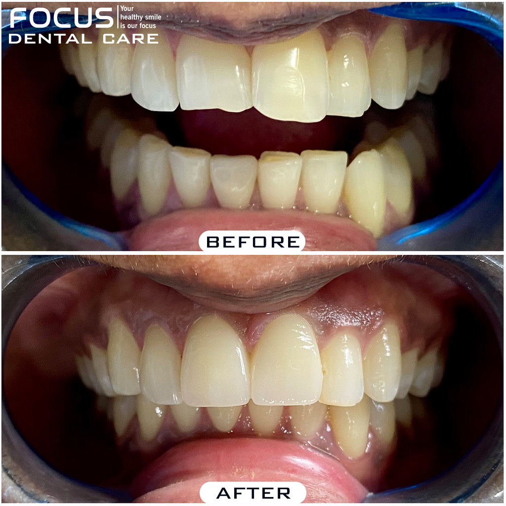 Smile Designing in Hyderabad 📌Smile Designing By Our Cosm… Flickr