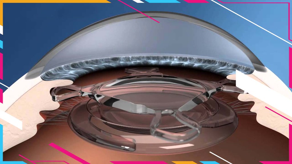 EyeMax Lens Implant For Macular Degeneration EyeMax is a p… Flickr