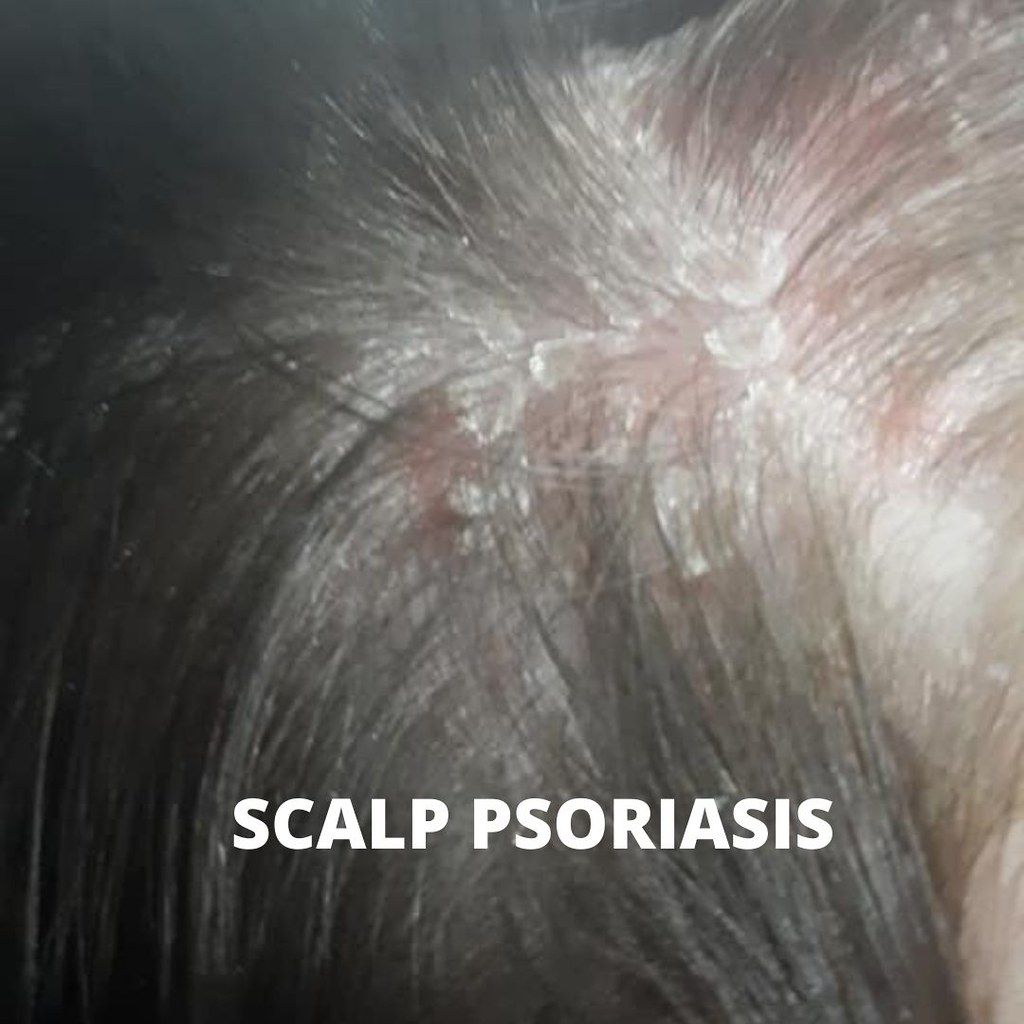 Deal with Scalp Psoriasis I have really bad psoriasis on m… Flickr