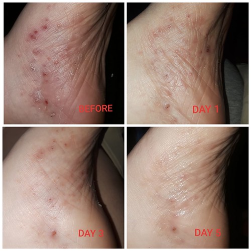 How to Treat Pustular Psoriasis on Feet believe that STRES… Flickr