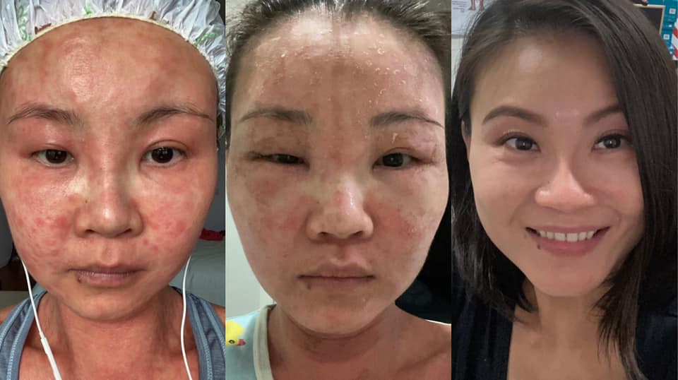 facial psoriasis treatment Ruja Sam Flickr