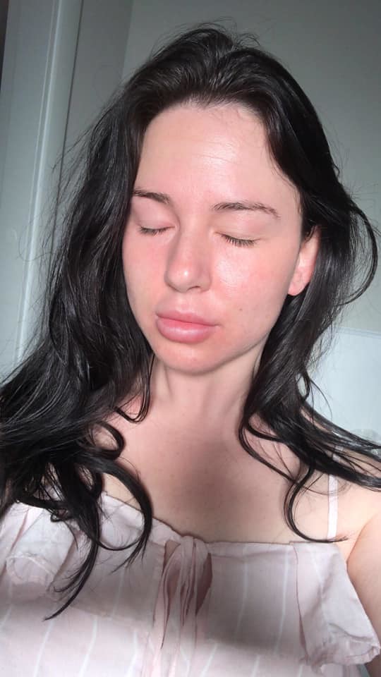 Sunburn Good for Psoriasis 3 psoriasis treatment Mr A PSO Flickr