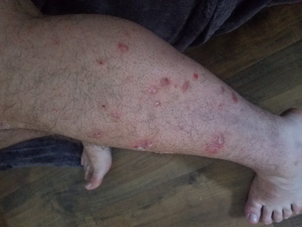 THE BEST Treatment for Psoriasis on Legs I mixed coconut o… Flickr