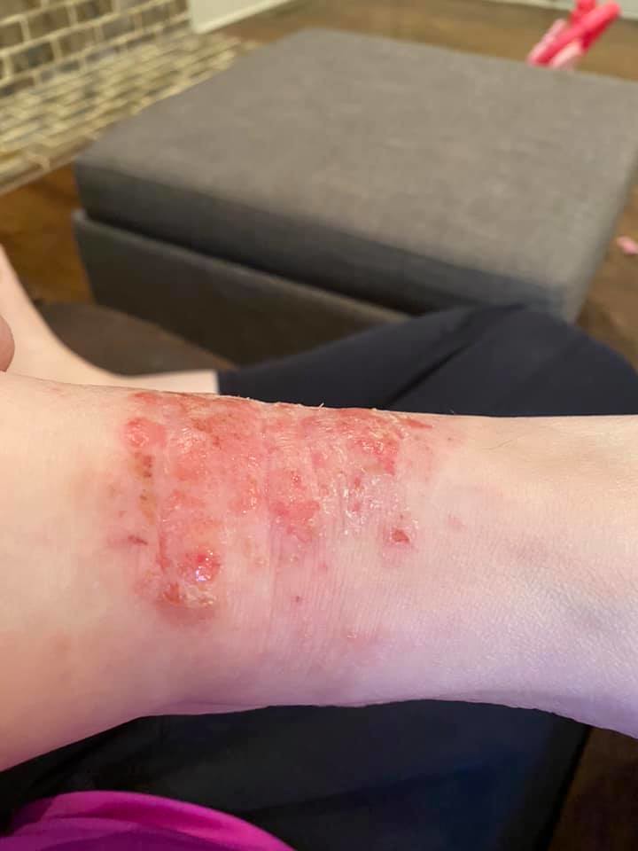 Relieve psoriasis itching Simple way to relieve psoriasis … Flickr