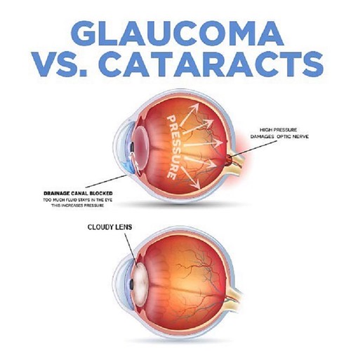 vs cataract is an eye disease/condition … Flickr