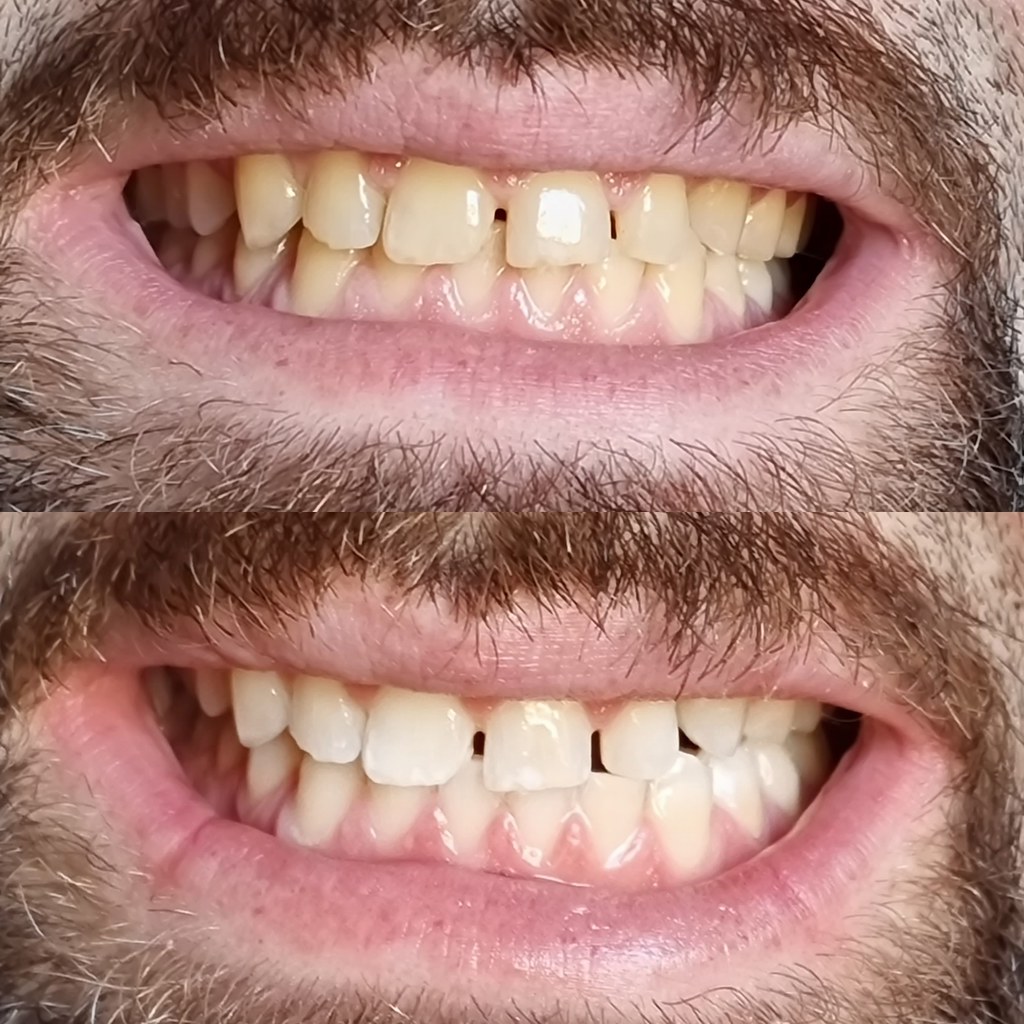 Teeth Whitening Dentist in Melbourne Celebrating a birthda… Flickr