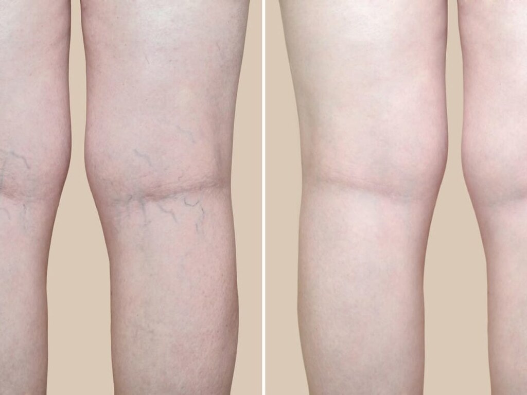 Do Spider Veins Come Back After Laser Treatment? Spider ve… Flickr