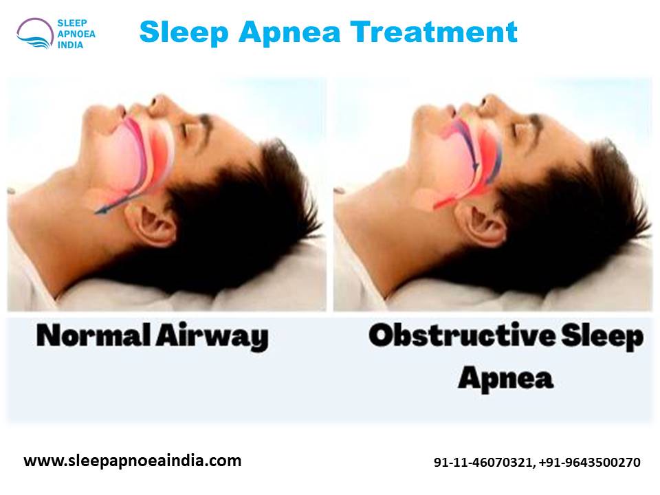 Sleep Apnea Treatment Flickr