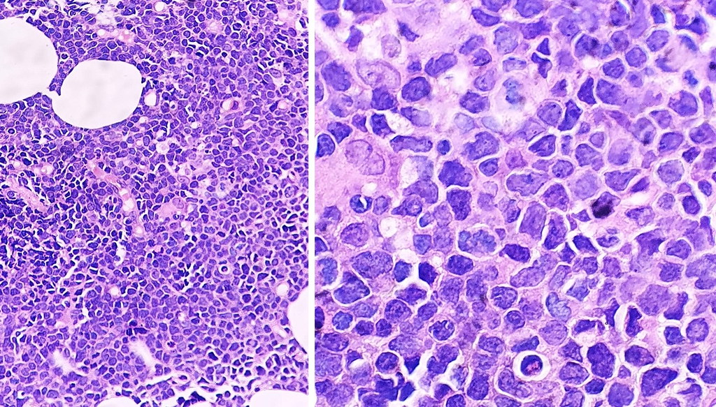 Small cell carcinoma These images nicely illustrate the ty… Flickr