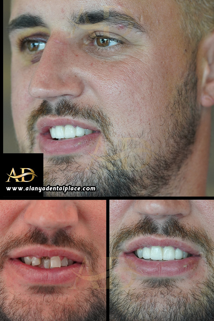 beforeafterşablon2 Alanya Dental Clinic Before & After … Flickr