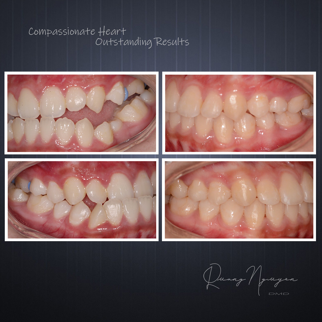 Class III underbite treated with expander Lawrenceville, G…