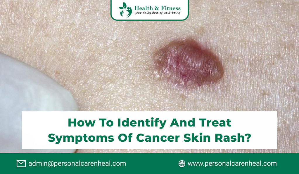 How to Identify and Treat Symptoms of Cancer Skin Rash_ Flickr