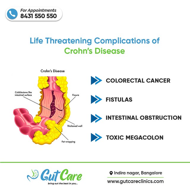 Life Threatening Complications of Crohn's Disease A type o… Flickr
