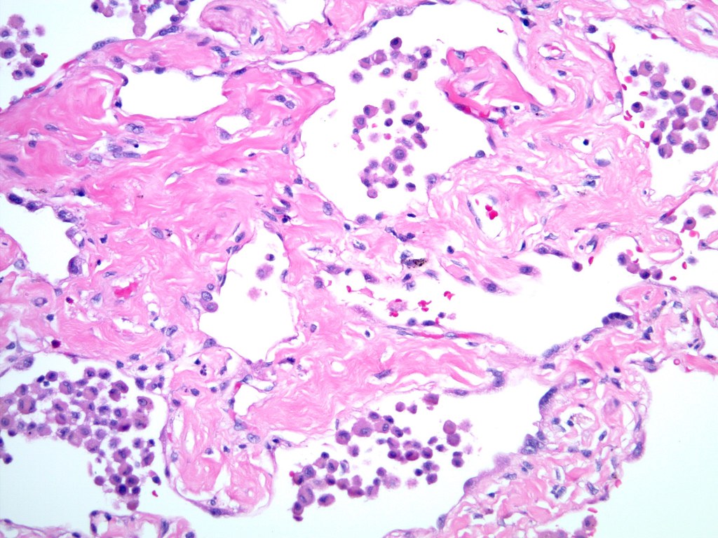 Smokingrelated interstitial fibrosis Typical appearance o… Flickr