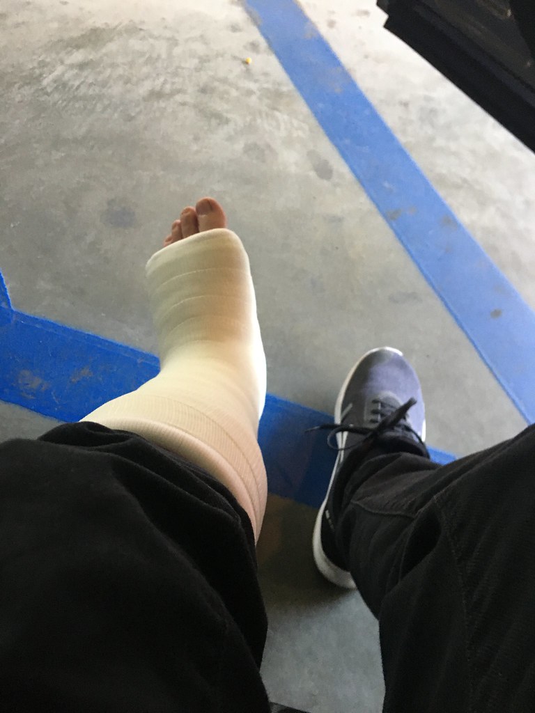 How Long In Cast After Achilles Surgery at Allan Campbell blog