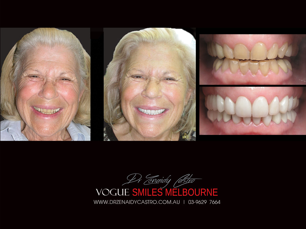 FACELIFT DENTISTRY PROCEDURES MELBOURNE Flickr