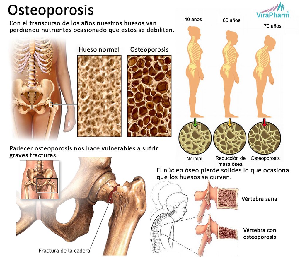 OSTEOPOROSIS (Infografía) La osteoporosis es una enfermeda… Flickr