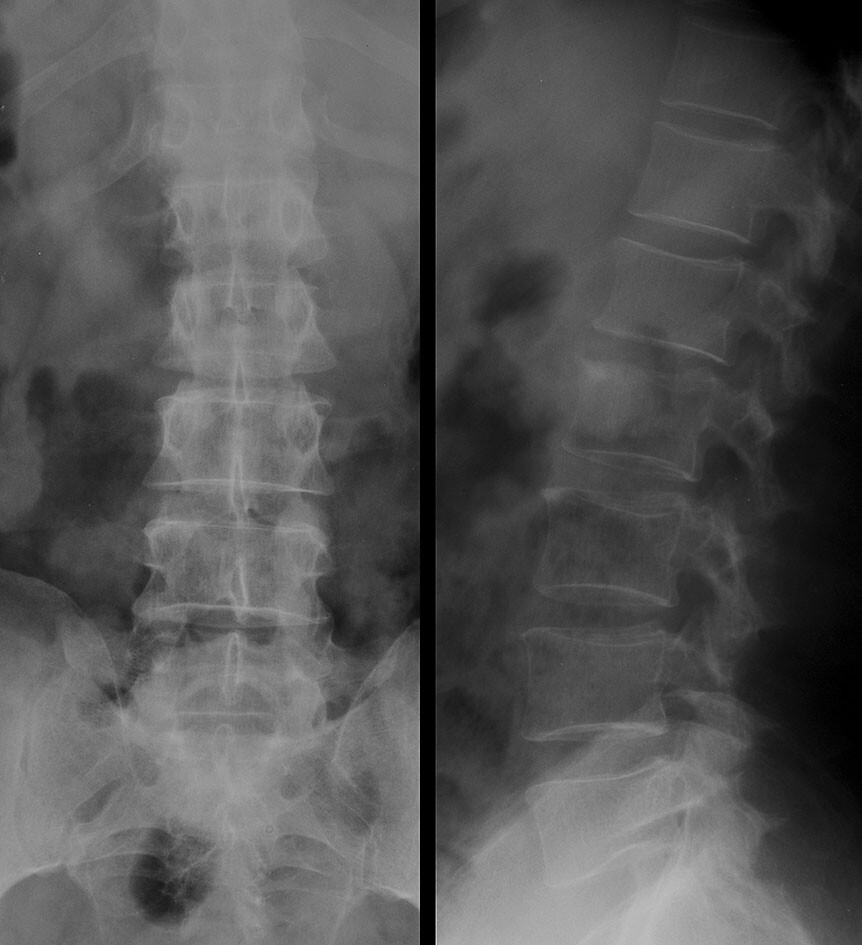 Bacterial osteomyelitis & disciitis, spine XR (1 of 2) Flickr