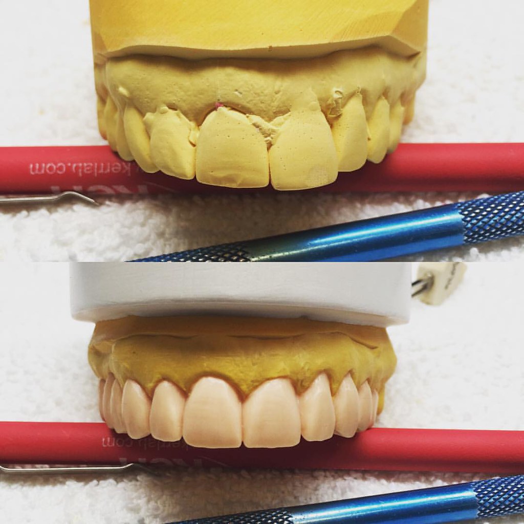 Did this earlier today. wax sculpting dental dentaltec… Flickr